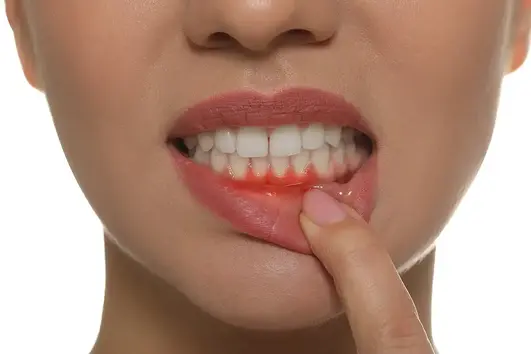 علت خونریزی لثه در ارتودنسی و راه حل آن - بررسی علل و روش‌های درمان