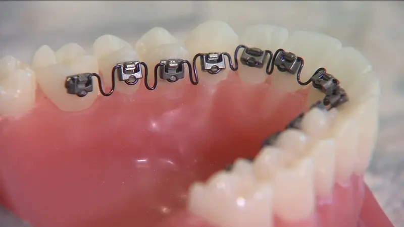 ارتودنسی از پشت دندان