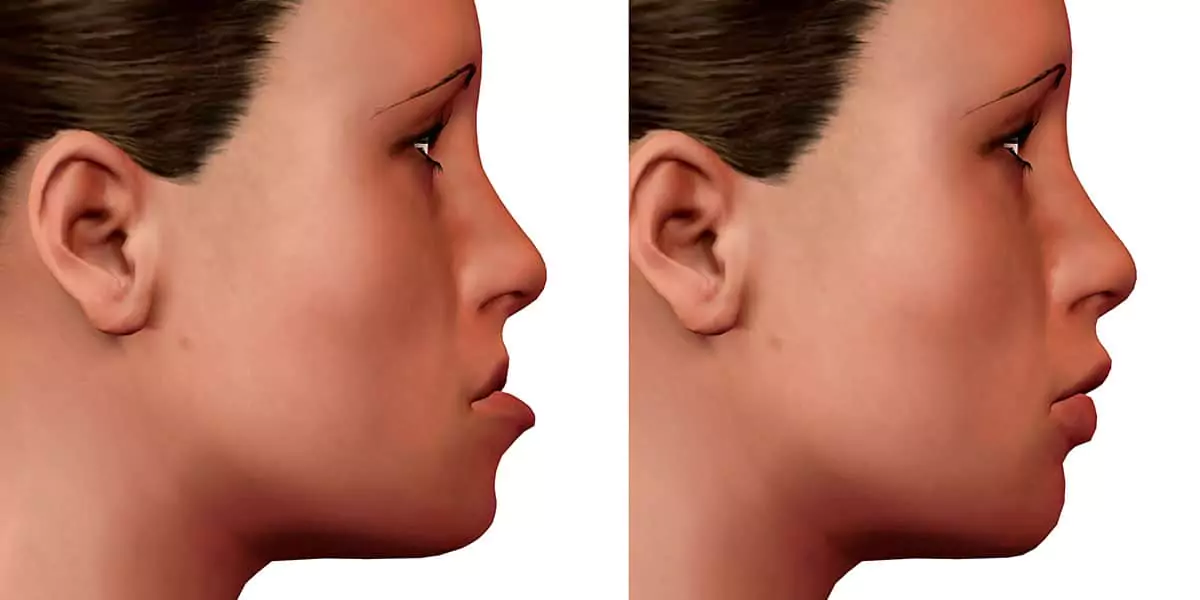 ارتودنسی فک پایین بدون نیاز به جراحی | روش‌های غیرتهاجمی اصلاح فک پایین