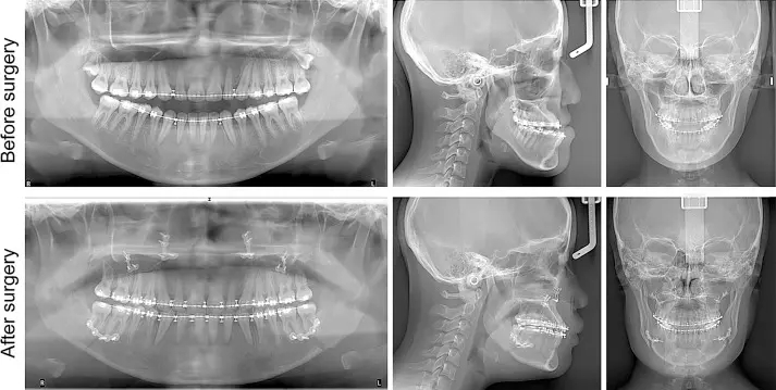 تصویر رادیولوژی فک پس از جراحی فک