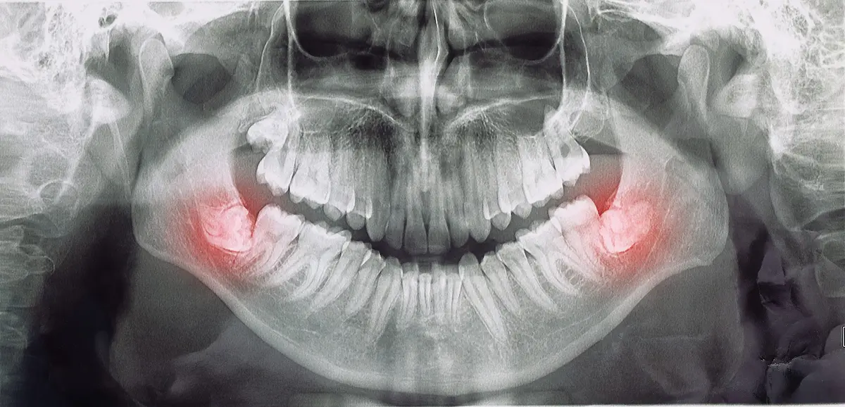 تصویربرداری از دندان عقل